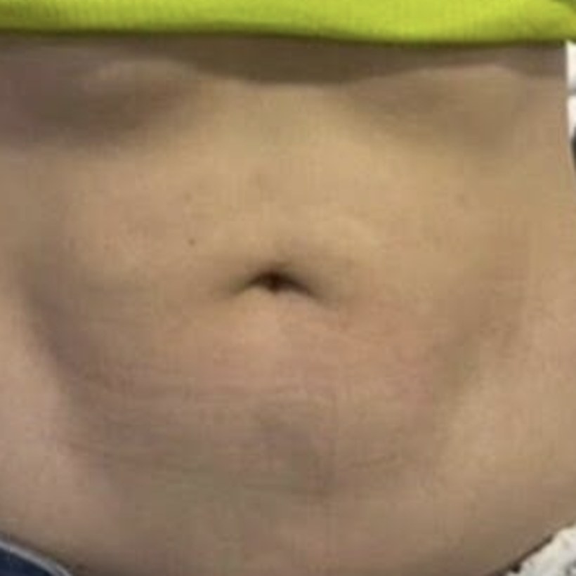 Antes de EmZero — abdomen