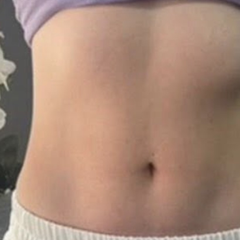 Después de EmZero — abdomen