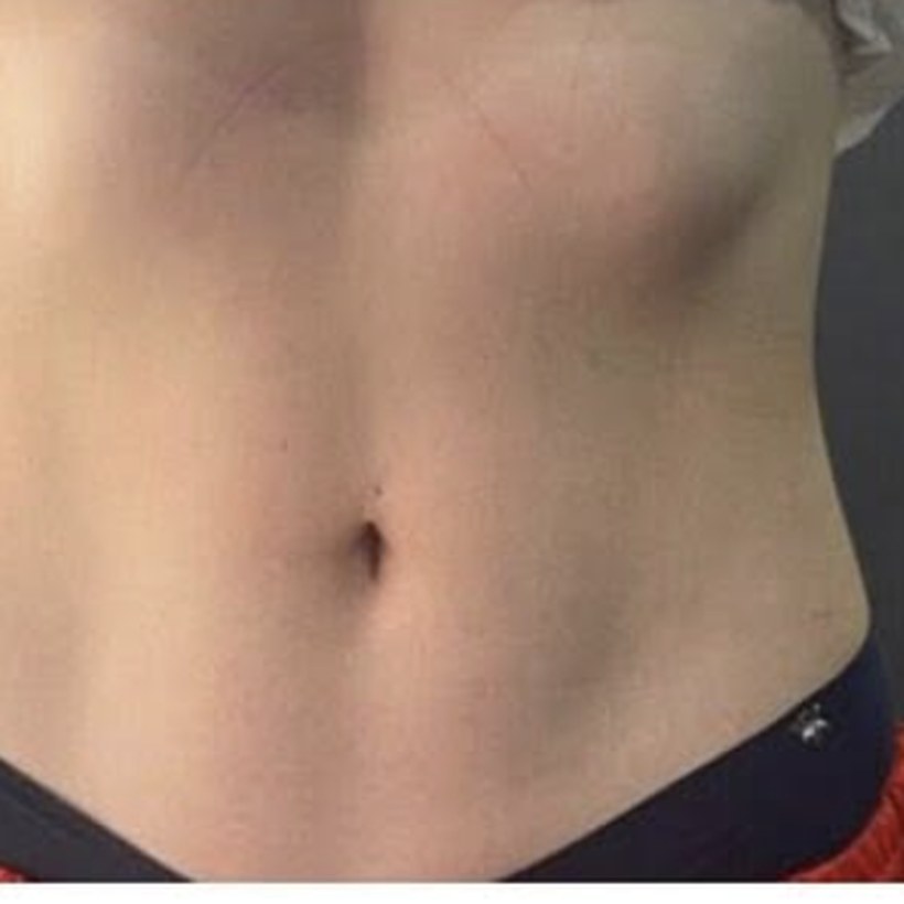 Antes de EmZero — abdomen