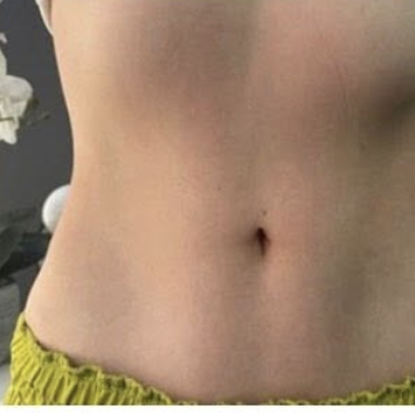 Después de EmZero — abdomen