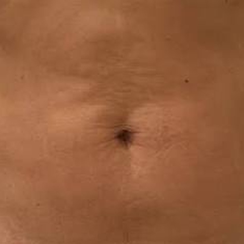 Antes de EmZero — abdomen
