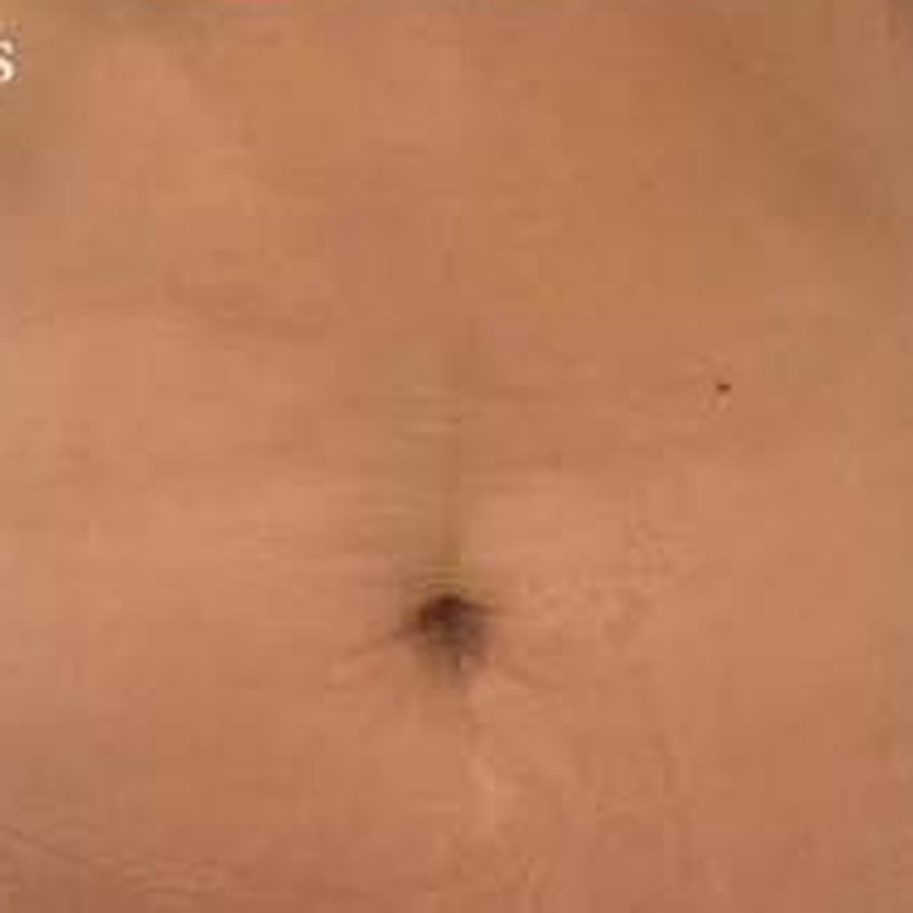 Después de EmZero — abdomen