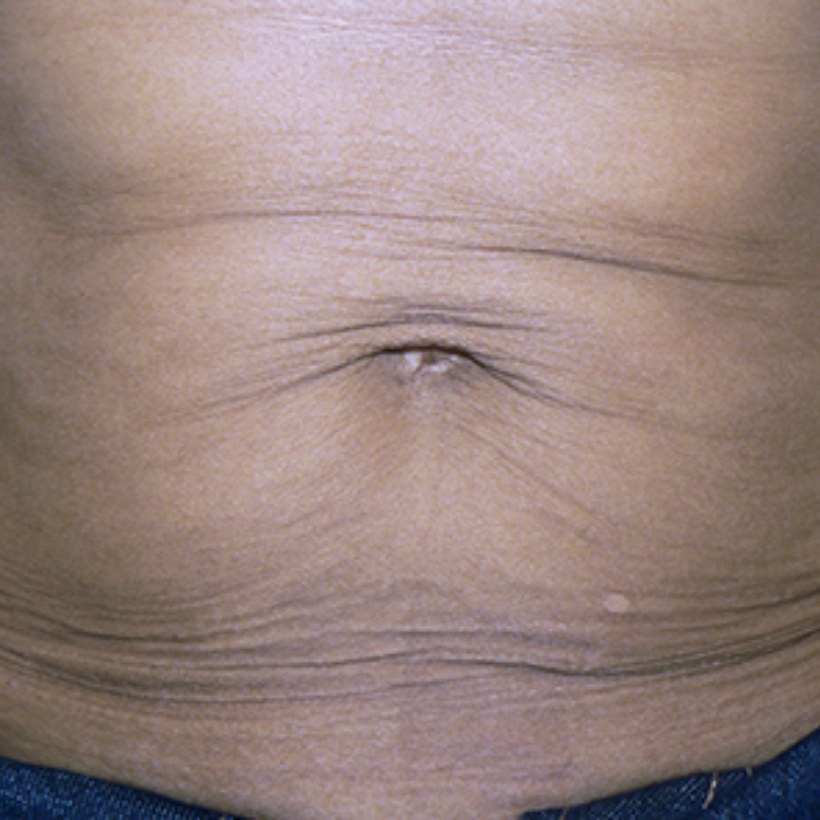 Antes del tratamiento Exilis 360 — abdomen
