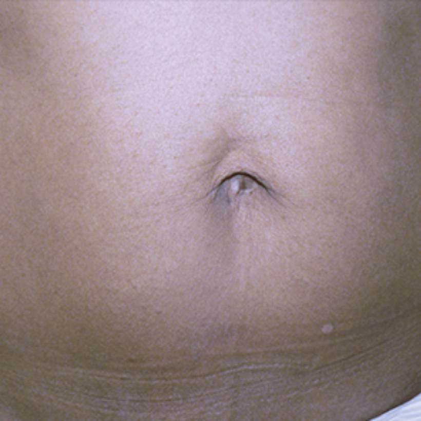 Después del tratamiento Exilis 360 — abdomen