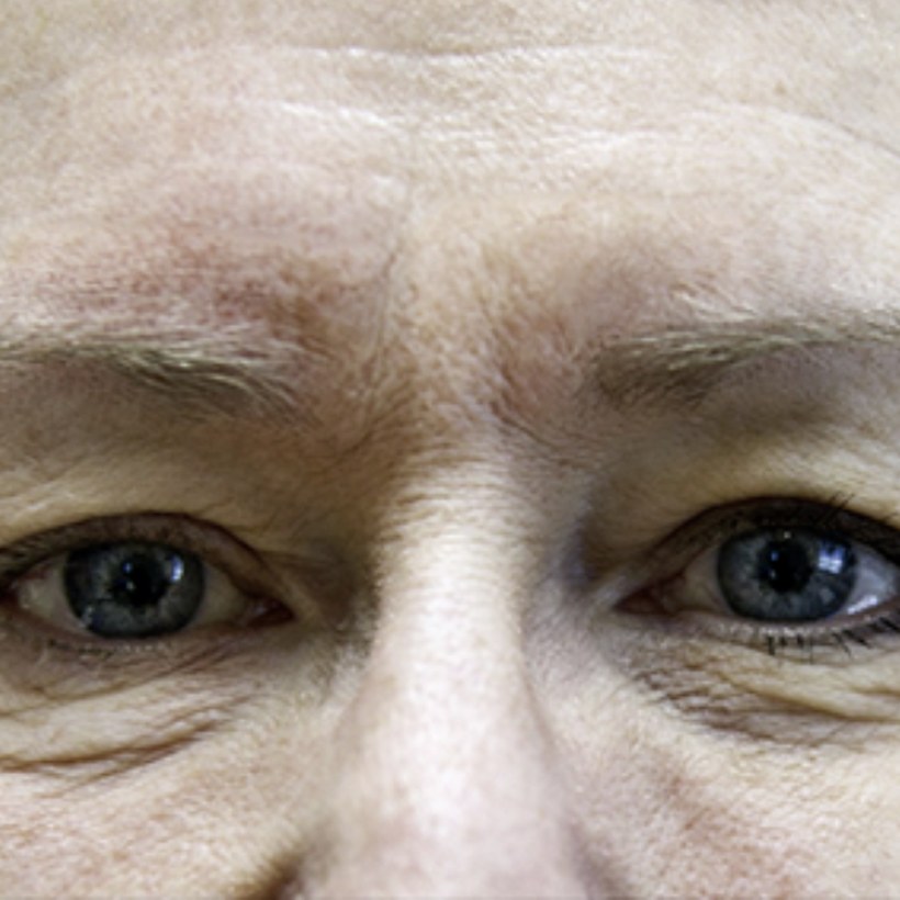 Antes del tratamiento Exilis 360 — rostro