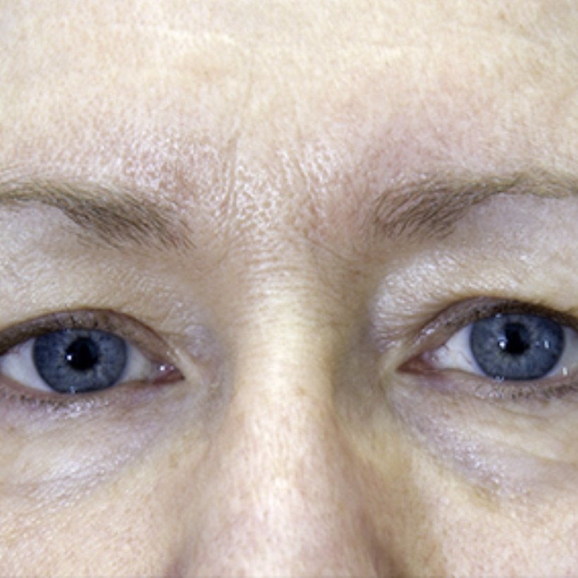 Después del tratamiento Exilis 360 — rostro