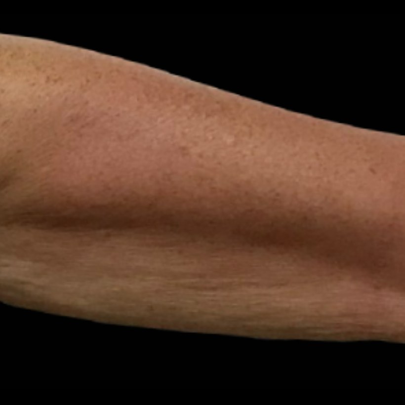 Después del tratamiento Exilis 360 — brazos