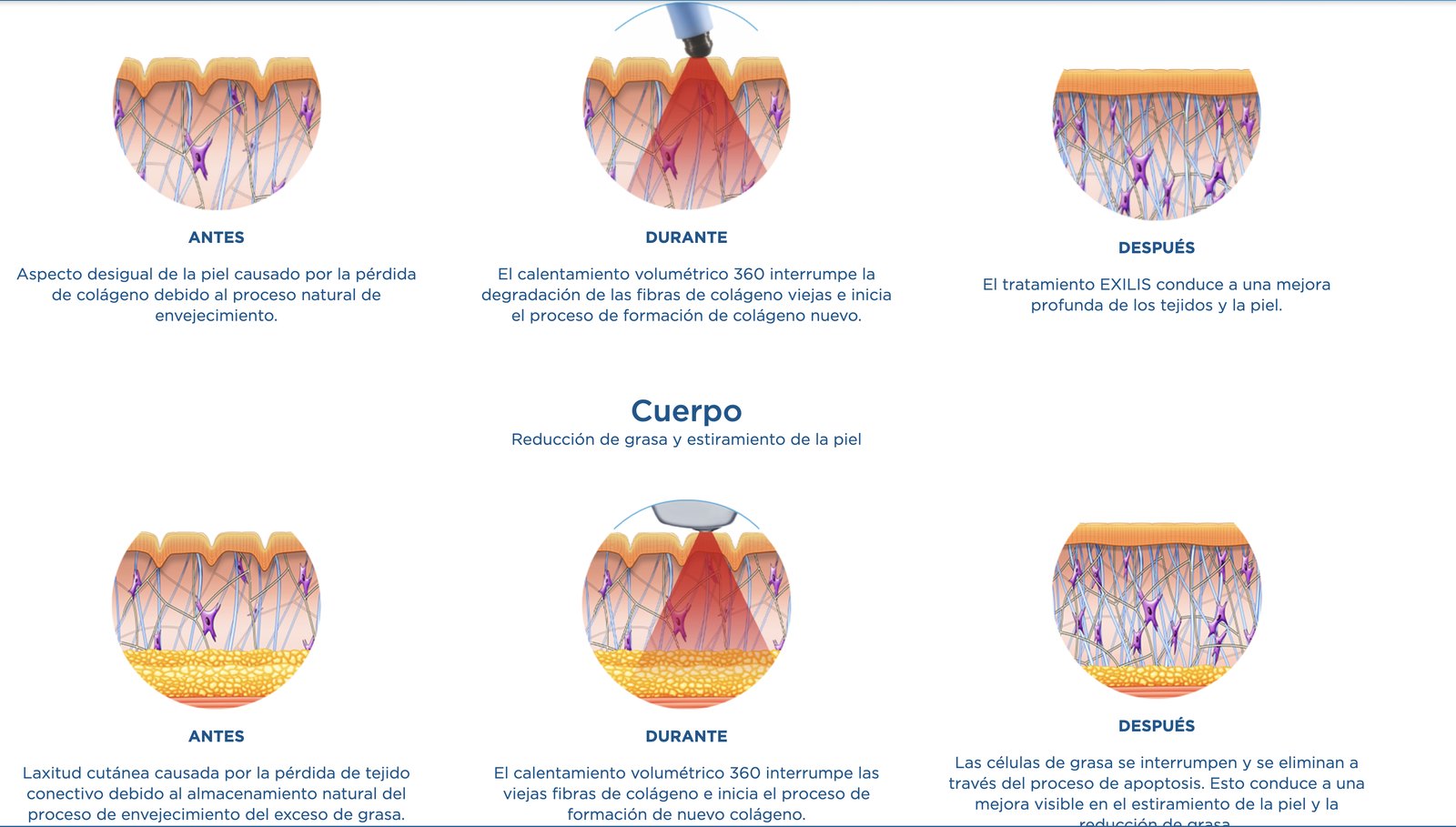 Cómo actúa Exilis Ultra 360 en rostro y cuerpo: antes, durante y después del tratamiento